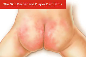 The Skin Barrier and Diaper Dermatitis